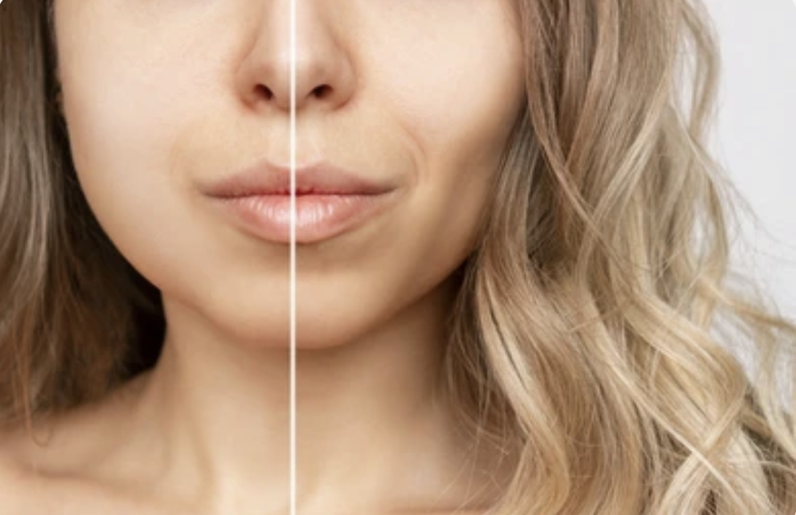 Buccal Fat Removal: The Latest Celebrity Trend That Promotes Self ...